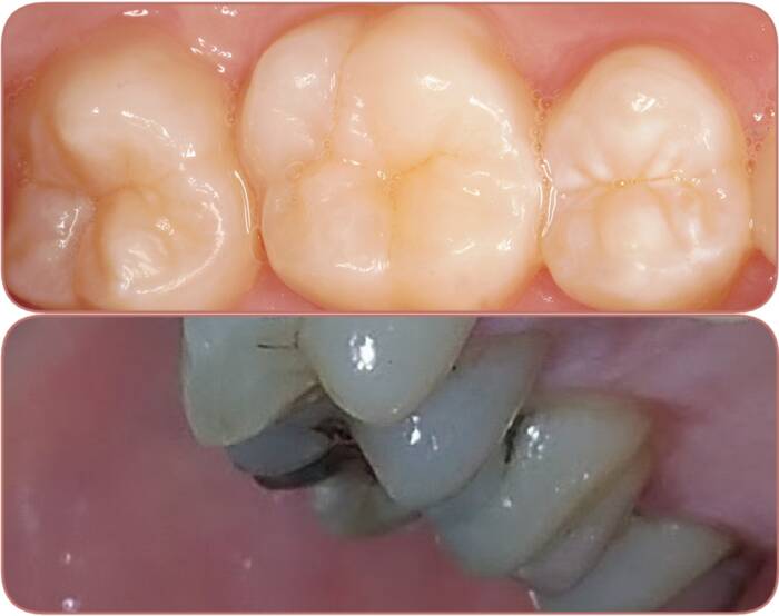 black spot on molar tooth
