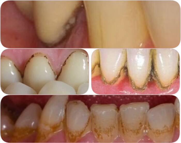 black stuff on teeth near gums