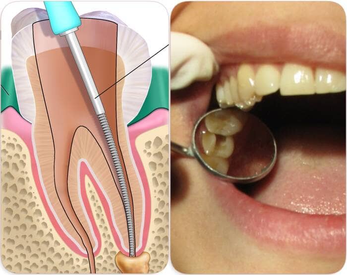 Can a root Canalled tooth get infected