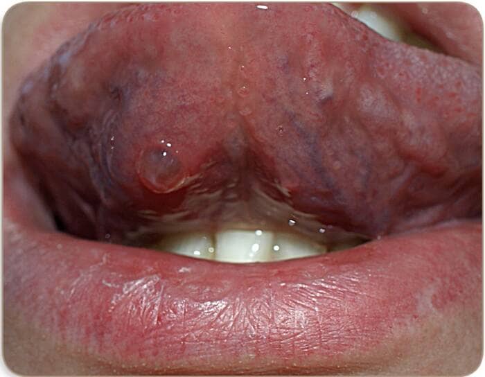How do I get rid of a mucous cyst in my mouth