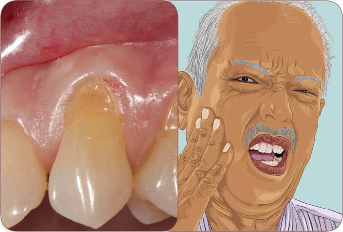 How do you treat inflamed and irritated gums