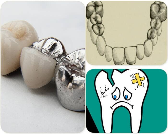 How long should a dental bridge last (lifespan)