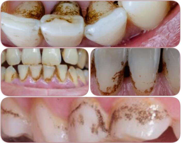 How to remove black stains from teeth