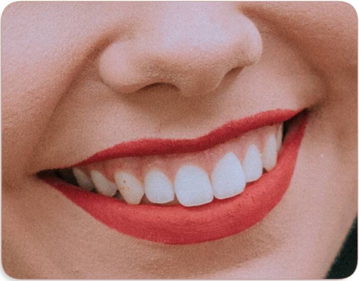Veneers teeth pros and cons