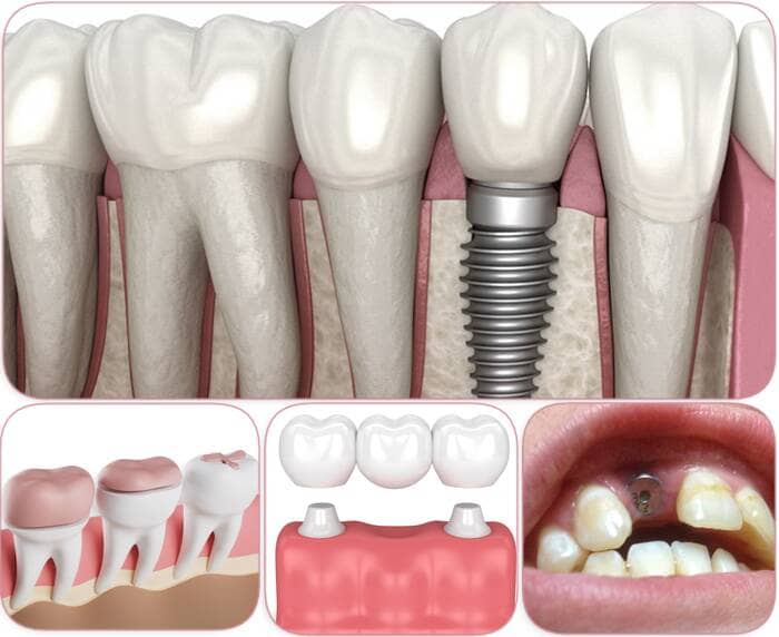 What can you do instead of dental implants