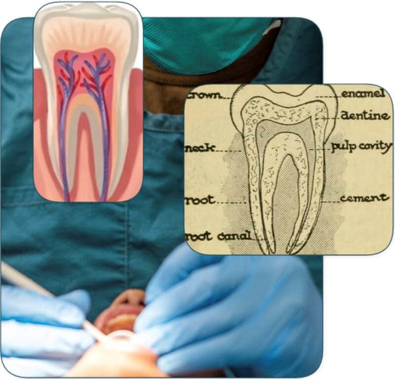 What happens if your tooth breaks after a root canal