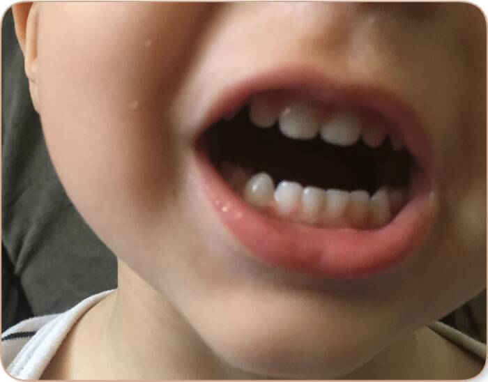 permanent tooth growing behind baby tooth