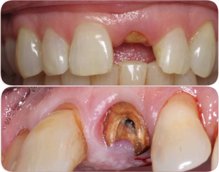 tooth broken at gum line (treatments)