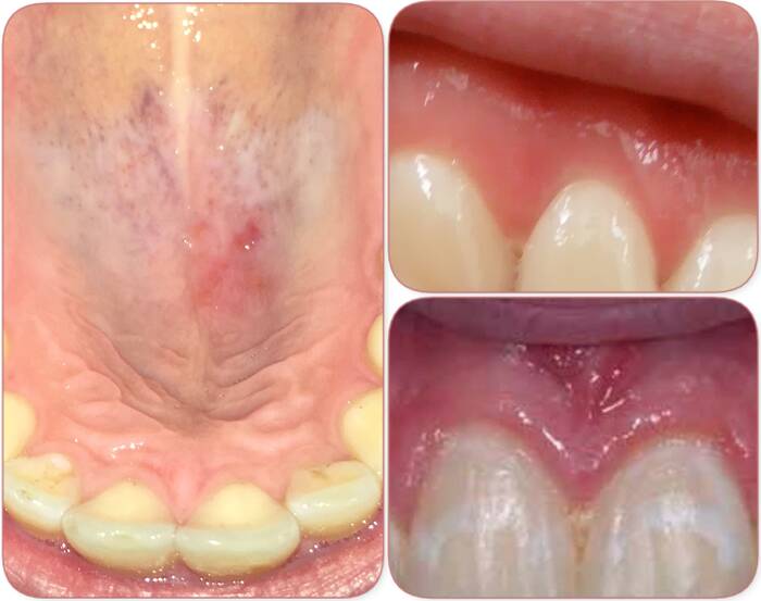 white spot on gums and mouth with no pain