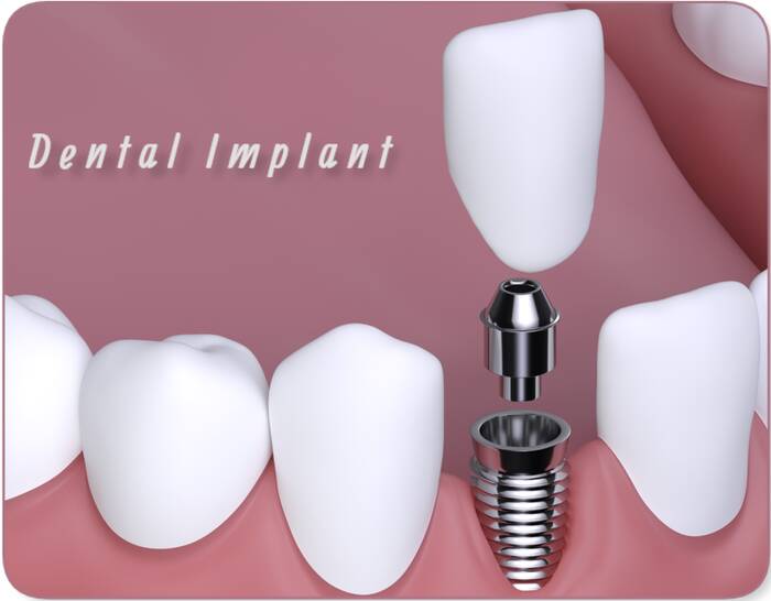 dental implant problems years later