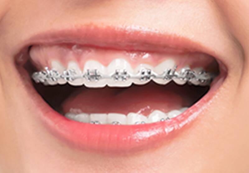 Meaning of Orthodontics