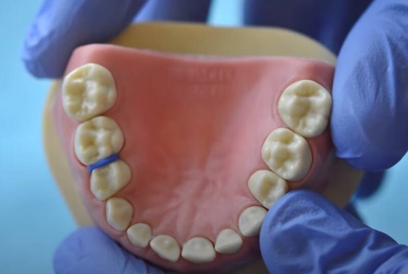 Separators orthodontics painful