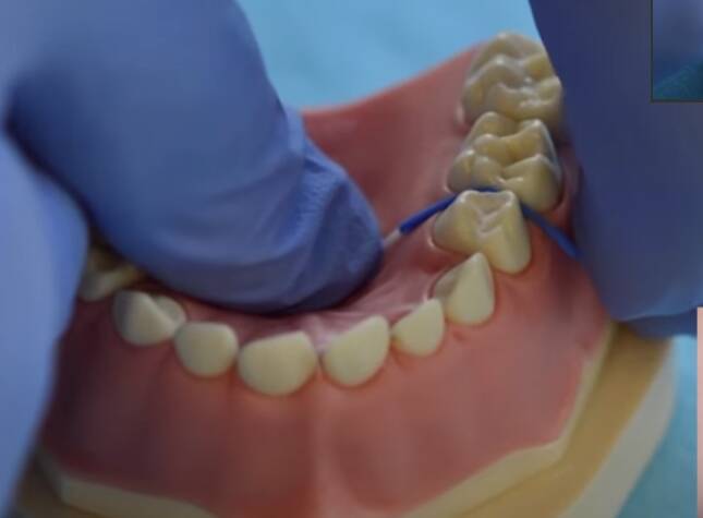 how to insert separators orthodontics between teeth