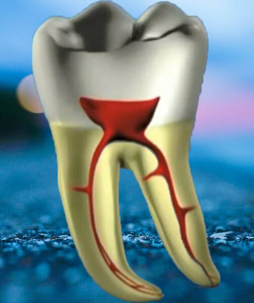 Root Canal Procedure