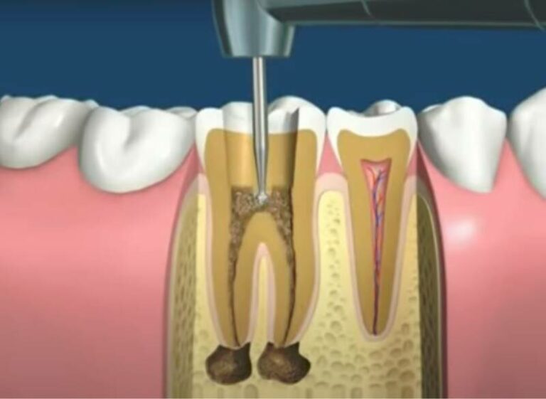 can-a-root-canal-cause-a-headache-is-it-possible