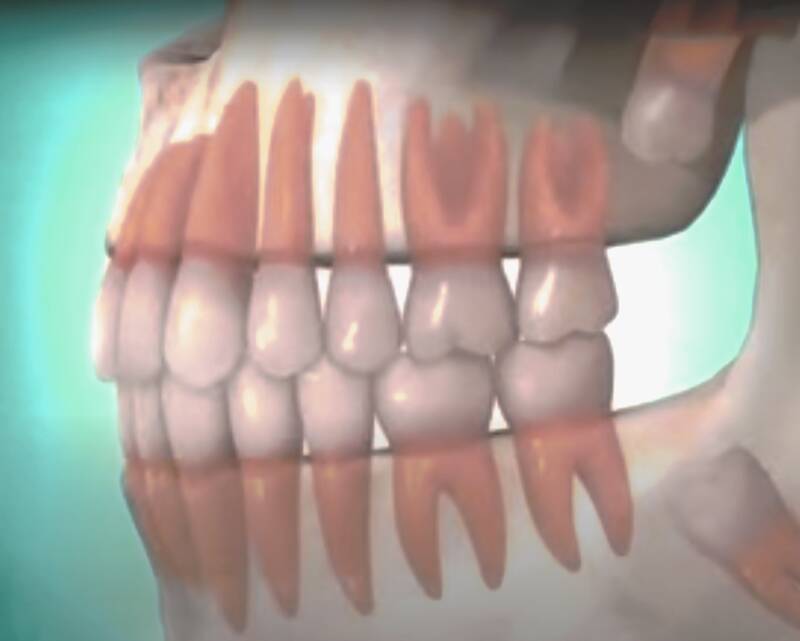 wisdom tooth extraction 