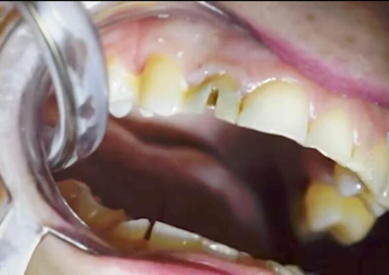 Can You Put a Crown On a Cracked Tooth?