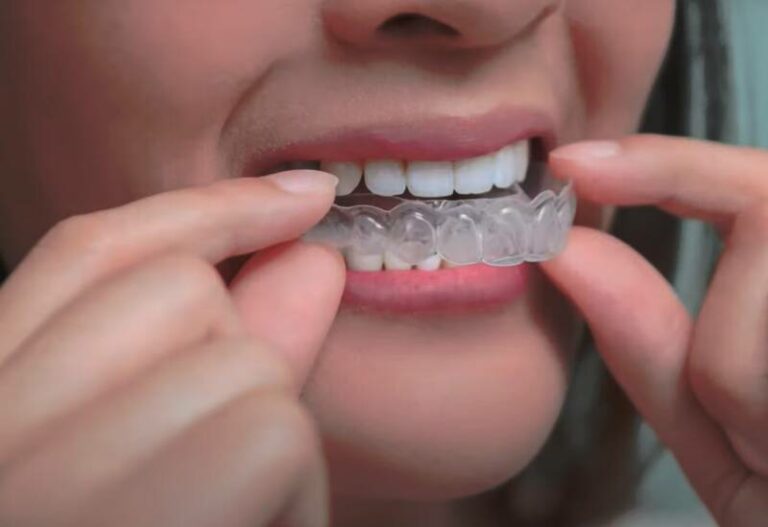 Should I Wear My Retainer If My Gums Are Swollen?