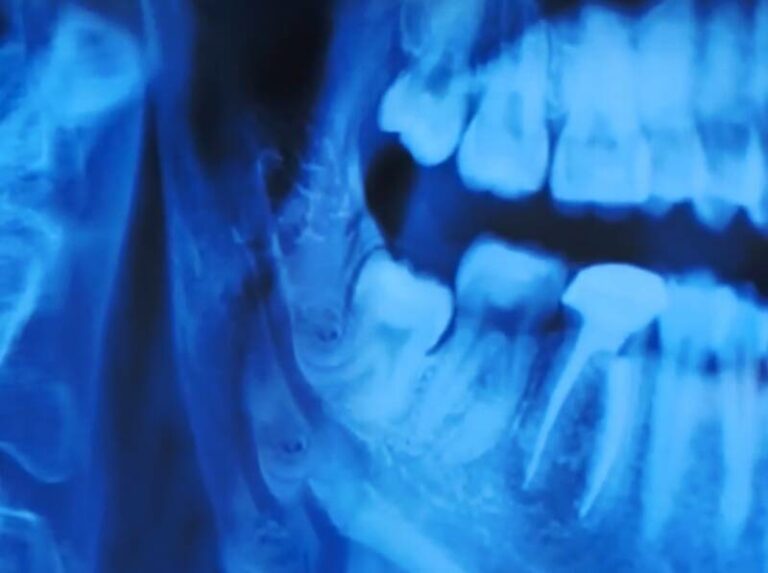 Curved Root Teeth What Is Teeth Dilaceration?