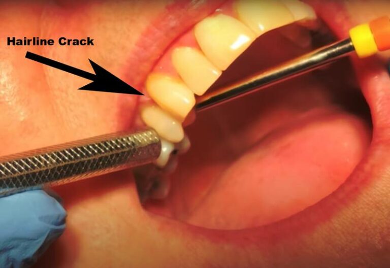 Can A Hairline Crack In A Tooth Heal Itself?