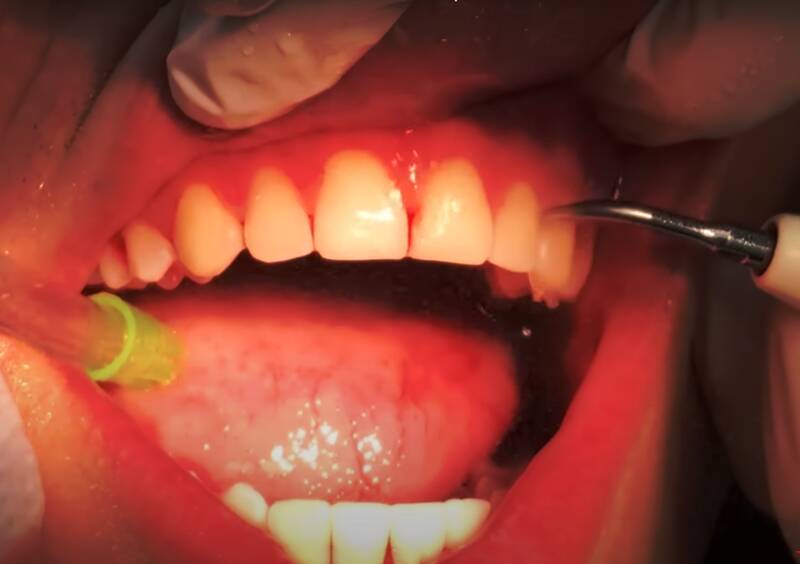 Does Anemia Cause Gums to Bleed