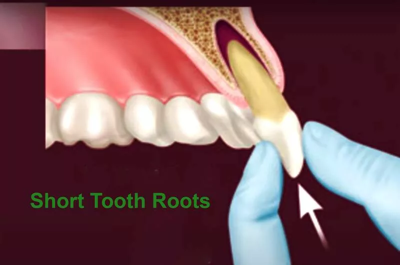 Short Tooth Roots