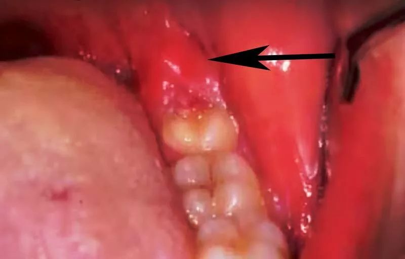 Will pericoronitis go away on its own